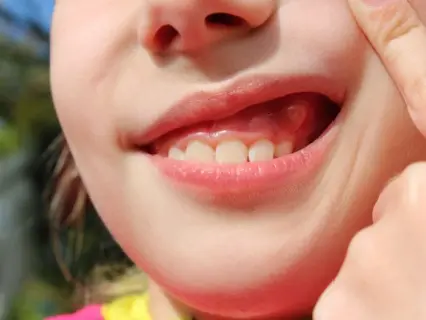 Signs of Abscess or Dental Infection in Your Child - Kid Grins