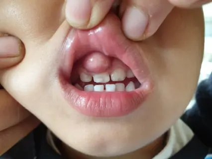 What Is a Dental Abscess - Kid Grins Explains