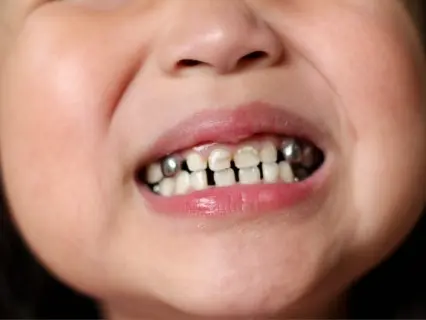 Why Baby Teeth Sometimes Need Dental Crowns - Kid Grins Can Help you Decide If Your Child Needs Them